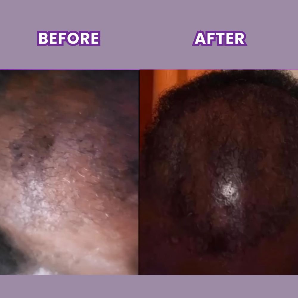 Alopecia Leave-In Hair Growth Tonic