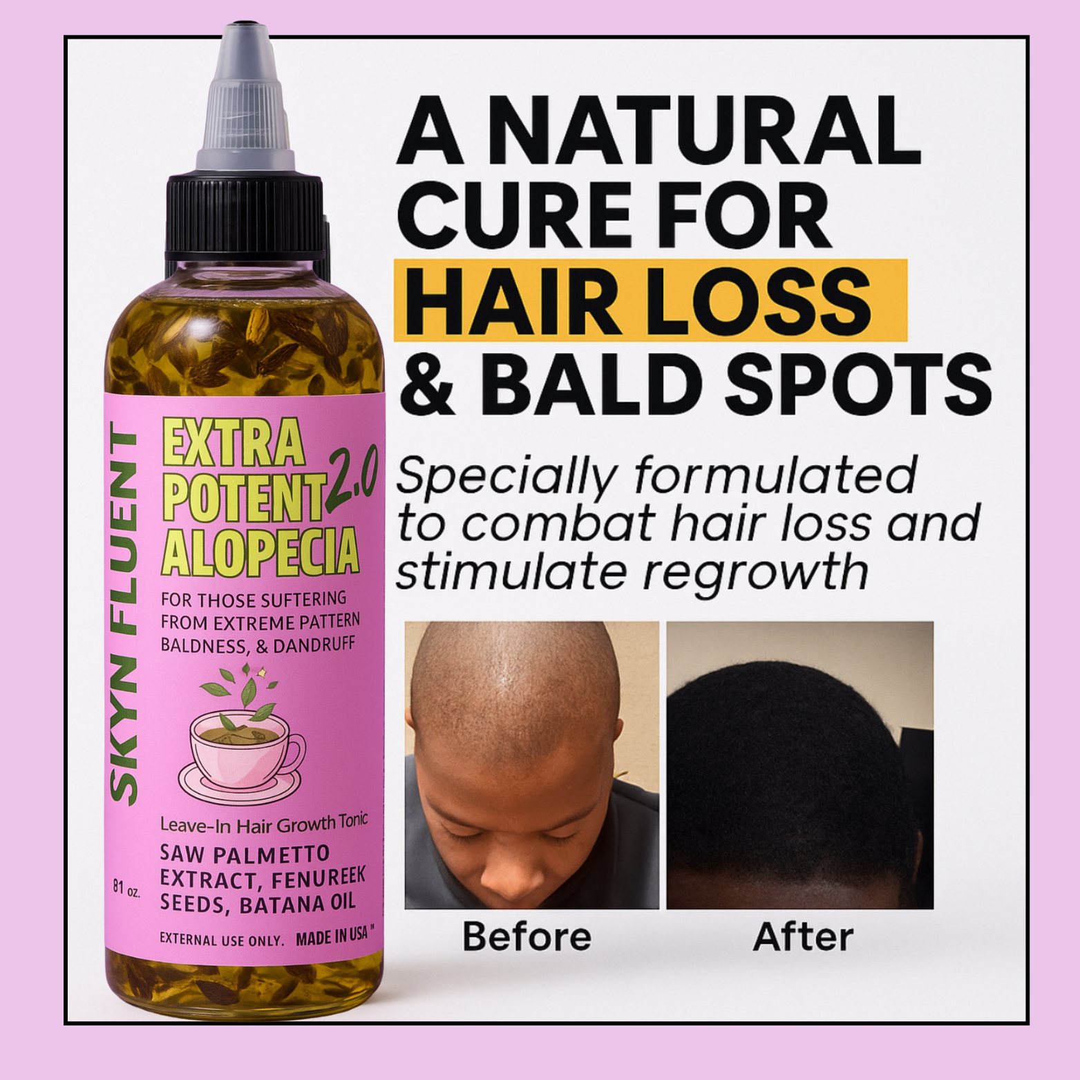 Skynfluent Extra Potent Alopecia Hair Growth Tonic for hair loss and bald spots – before and after results showing improved hair regrowth