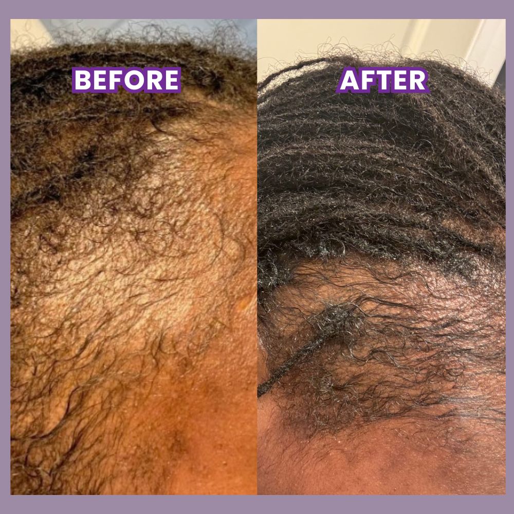 Before and after results showing hair regrowth and thicker edges using Skynfluent Extra Potent Alopecia Hair Growth Tonic