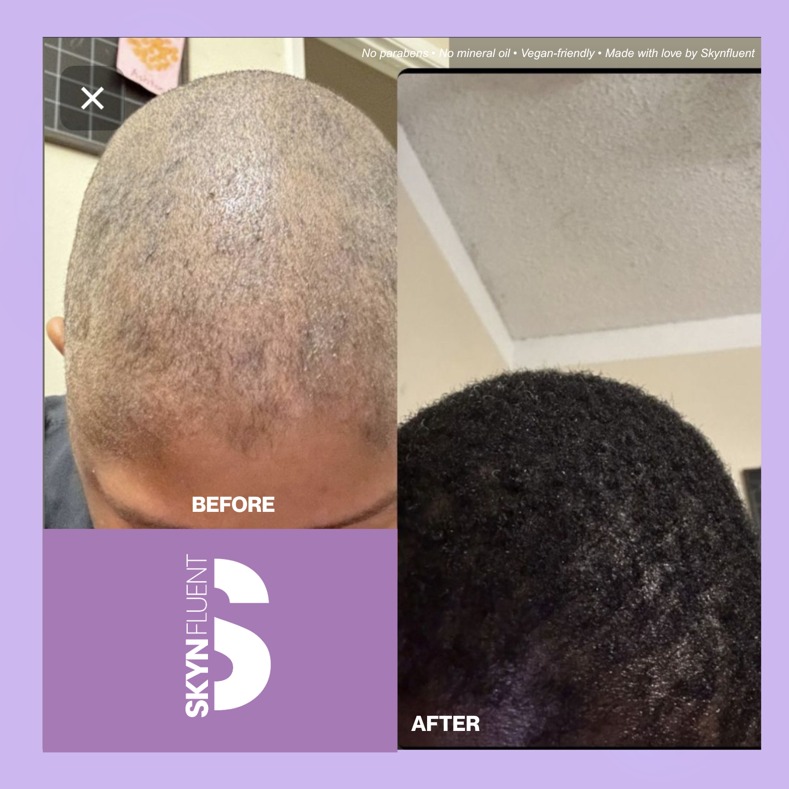 Before and after results showing hair growth and thickening after consistent use of Skyn Fluent natural hair products.