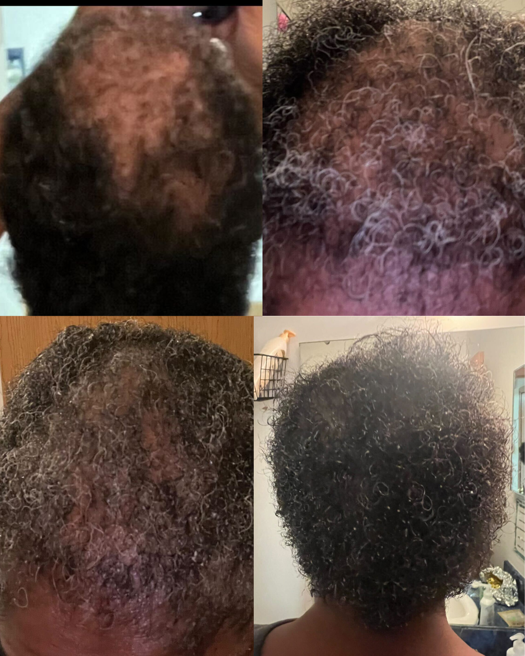 Alopecia Leave-In Hair Growth Tonic